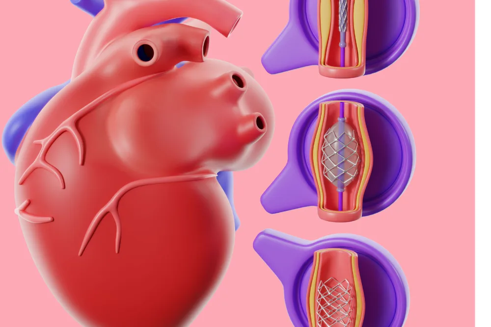 Colocación de Stent